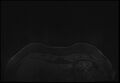 Normal breast MRI - dense breasts (Radiopaedia 80454-93850 Axial T1 1).jpg