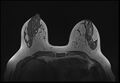 Normal breast MRI - dense breasts (Radiopaedia 80454-93850 Axial T1 83).jpg