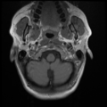 Normal cervical and thoracic spine MRI (Radiopaedia 35630-37156 Axial T1 33).png
