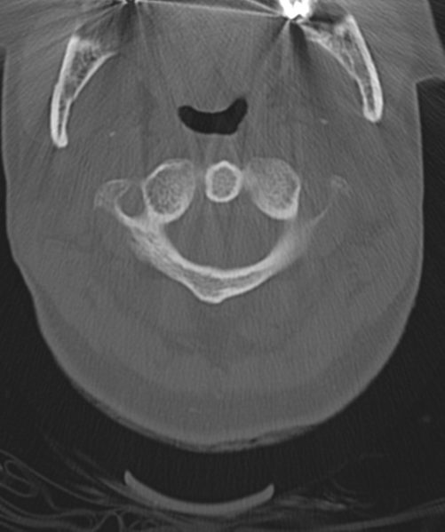 File:Normal cervical spine MRI (including Dixon) (Radiopaedia 42762-45926 Axial bone window 13).png