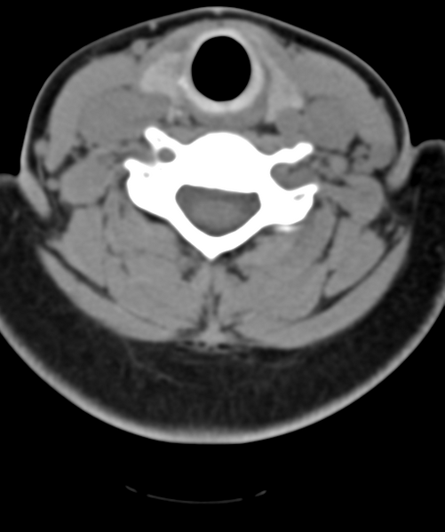 File:Normal cervical spine MRI (including Dixon) (Radiopaedia 42762-45926 Axial non-contrast 38).png