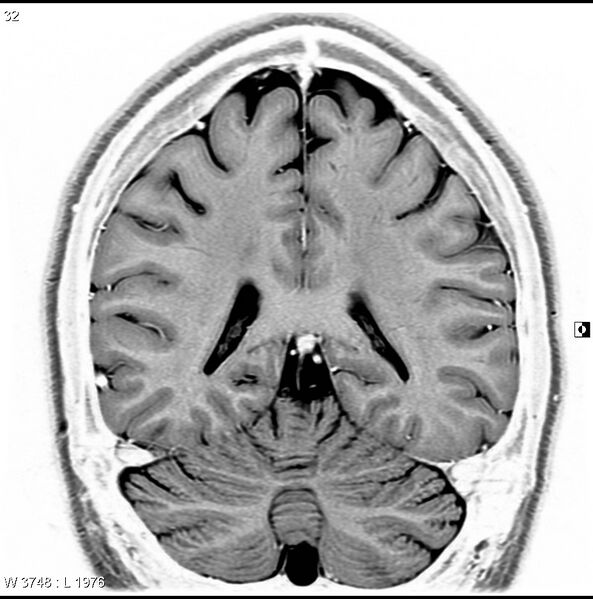 File:Normal coronal brain (Radiopaedia 6676-7910 B 32).jpg
