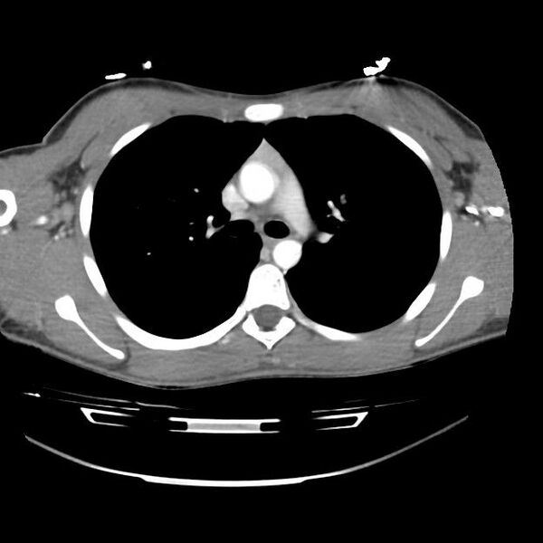 File:Normal dual-phase trauma CT chest,abdomen and pelvis (Radiopaedia 48092-52899 A 21).jpg