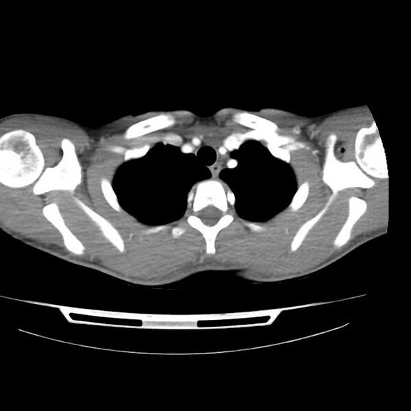 File:Normal dual-phase trauma CT chest,abdomen and pelvis (Radiopaedia 48092-52899 A 8).jpg
