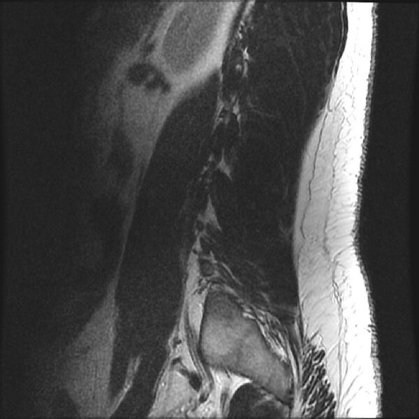 File:Normal lumbar spine MRI (Radiopaedia 43051-46311 Sagittal T2 1).jpg