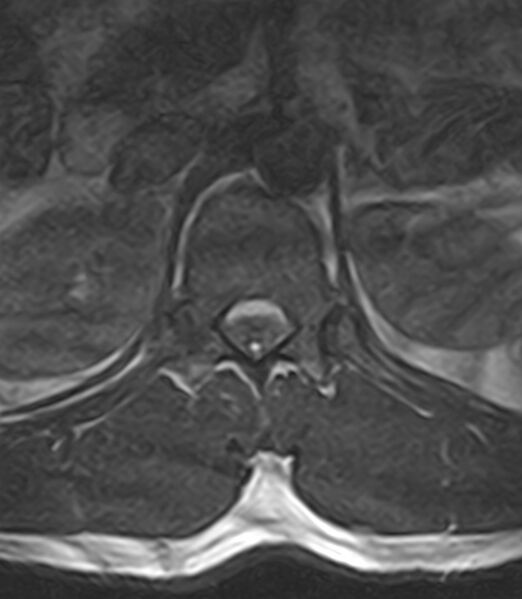 File:Normal lumbar spine MRI - low-field MRI scanner (Radiopaedia 40976-43699 Axial T2 12).jpg