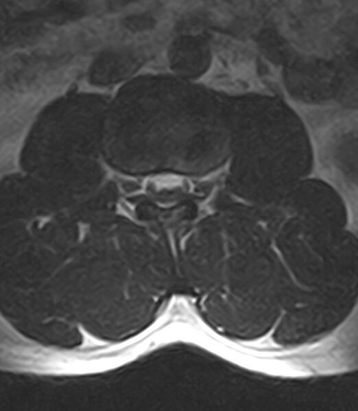 File:Normal lumbar spine MRI - low-field MRI scanner (Radiopaedia 40976-43699 Axial T2 44).jpg