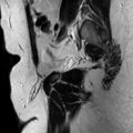 Normal prostate (MRI) (Radiopaedia 29986-30535 Sagittal T2 20).jpg