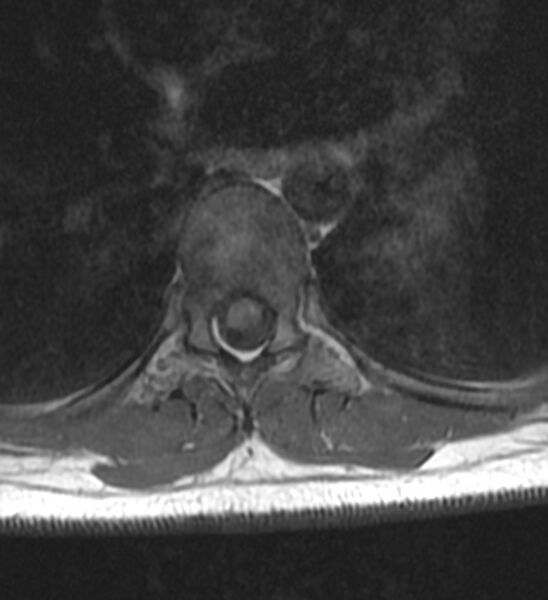 File:Normal thoracic spine MRI (Radiopaedia 41033-43781 Axial T1 3).jpg