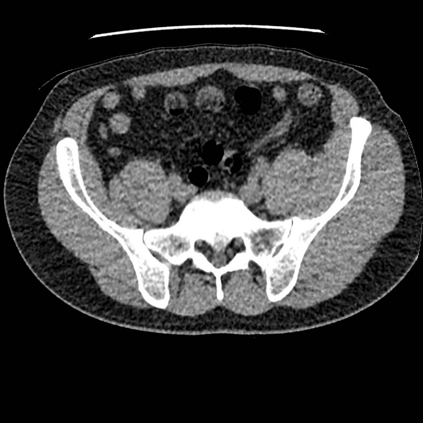 Obstructing ureteric calculus and ureteric anatomy (Radiopaedia 62730-71042 Axial non-contrast 116).jpg