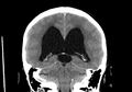 Obstructive hydrocephalus (Radiopaedia 30453-31119 Coronal non-contrast 25).jpg