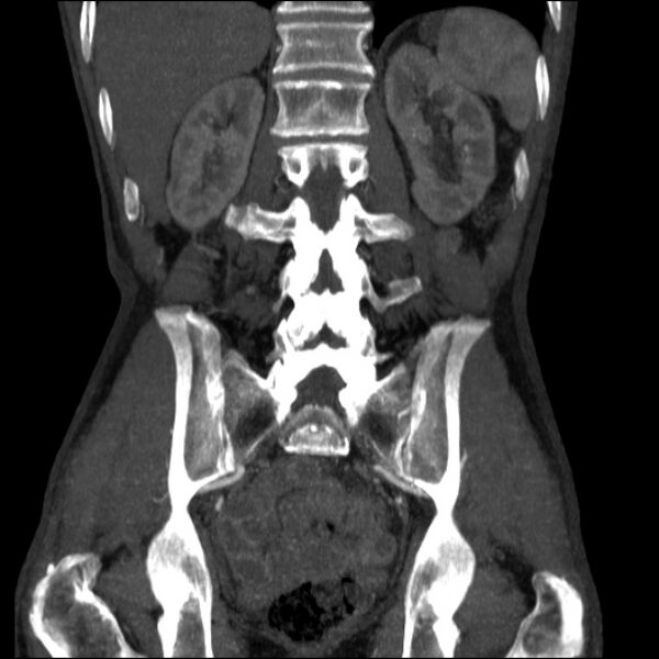 File:Abdominal aortic aneurysm (Radiopaedia 23703-23856 Coronal C+ arterial phase 25).jpg