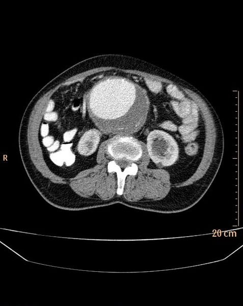 File:Abdominal aortic aneurysm (Radiopaedia 25985-26121 Axial C+ arterial phase 16).jpg