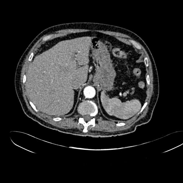 File:Abdominal aortic aneurysm (Radiopaedia 75131-86203 Axial C+ arterial phase 10).jpg