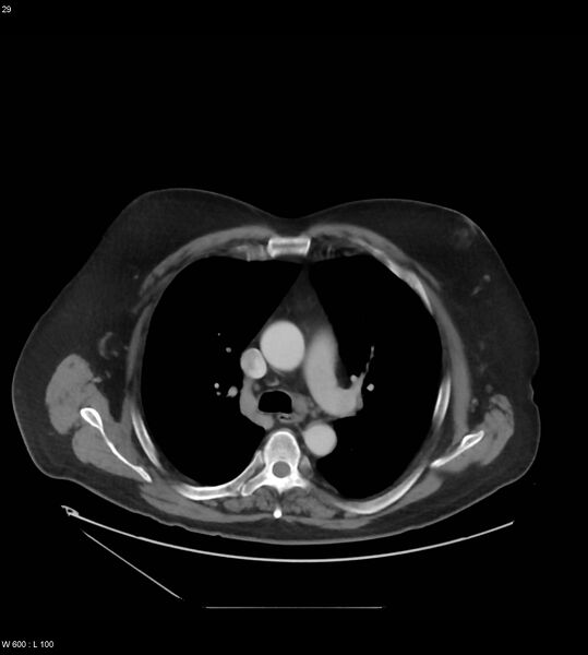 File:Abdominal aortic aneurysm with intramural hematoma then rupture (Radiopaedia 50278-55631 Axial C+ arterial phase 20).jpg