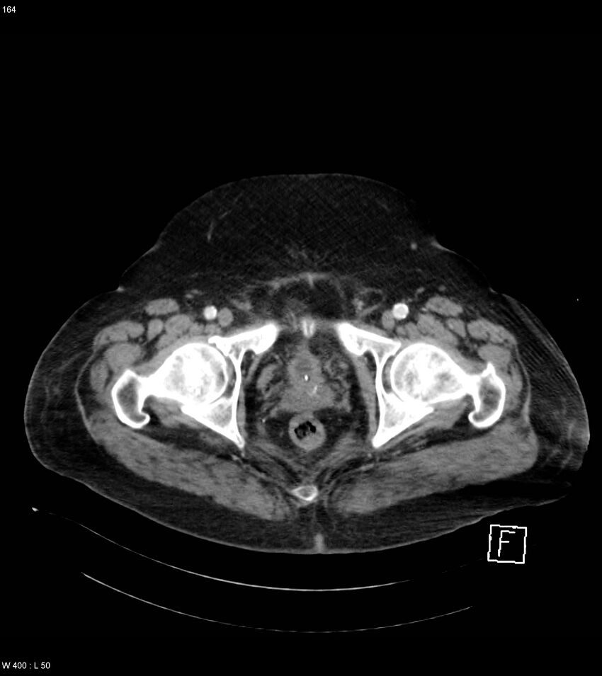Abdominal aortic aneurysm with intramural hematoma then rupture (Radiopaedia 50278-55632 Axial C+ arterial phase 163).jpg