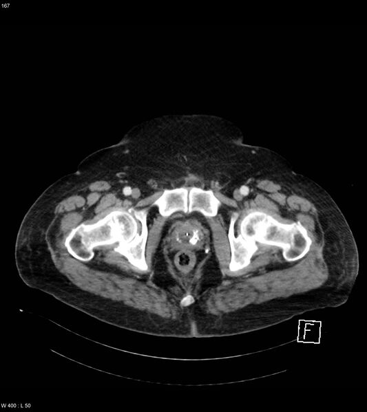 File:Abdominal aortic aneurysm with intramural hematoma then rupture (Radiopaedia 50278-55632 Axial C+ arterial phase 166).jpg