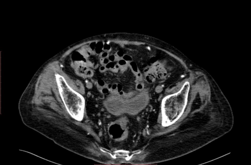 Abdominal aortic interposition tube graft and aneurysm thrombosis (Radiopaedia 71438-81857 Axial C+ arterial phase 201).jpg
