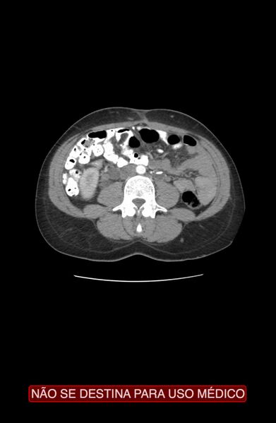 File:Abdominal desmoid tumor (Radiopaedia 44024-47540 Axial C+ arterial phase 17).jpg
