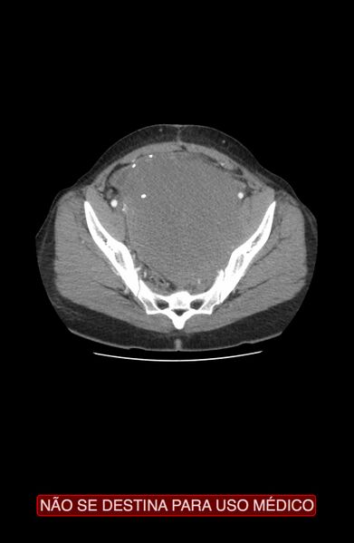 File:Abdominal desmoid tumor (Radiopaedia 44024-47540 Axial C+ arterial phase 39).jpg