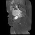 Abdominal wall endometriosis (Radiopaedia 83702-98847 Sagittal T1 C+ fat sat 13).jpg