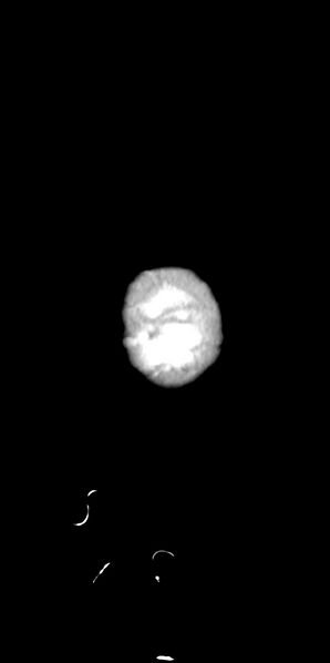File:Abdominopelvic rhabdomyosarcoma (Radiopaedia 78356-90984 Sagittal C+ portal venous phase 100).jpg