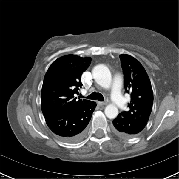 File:Acute-on-chronic pulmonary emboli (Radiopaedia 27925-28169 C+ CTPA 29).jpg