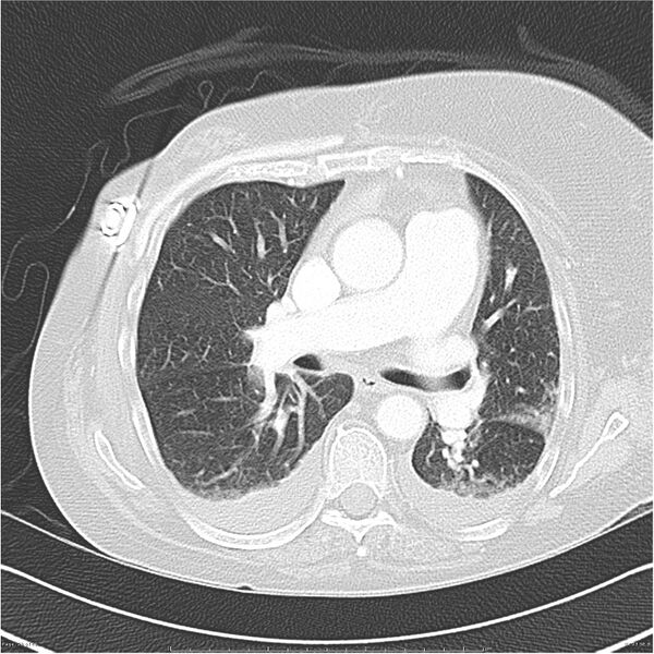 File:Acute-on-chronic pulmonary emboli (Radiopaedia 27925-28169 lung window 23).jpg