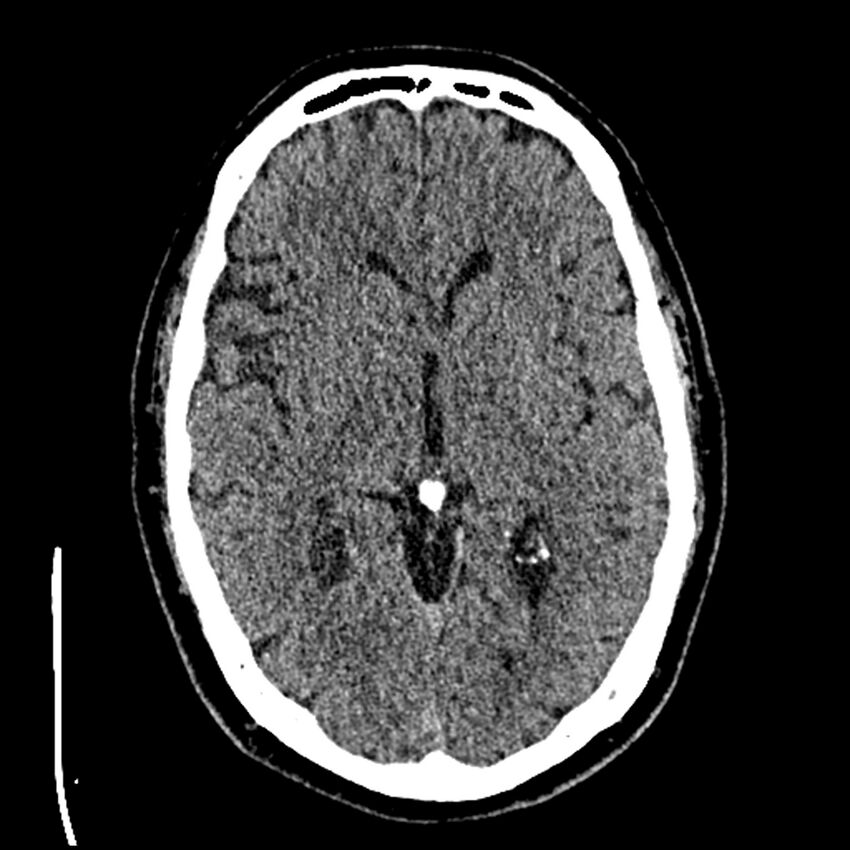 Acute A3 occlusion with ACA ischemic penumbra (CT perfusion) (Radiopaedia 72036-82525 Axial non-contrast thins 28).jpg