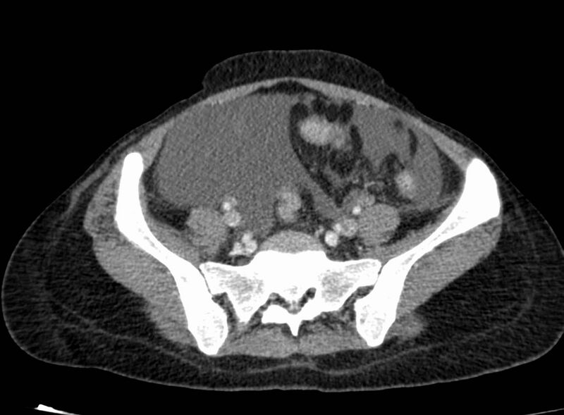 File:Acute Budd-Chiari syndrome (Radiopaedia 60858-68638 Axial C+ portal venous phase 225).jpg