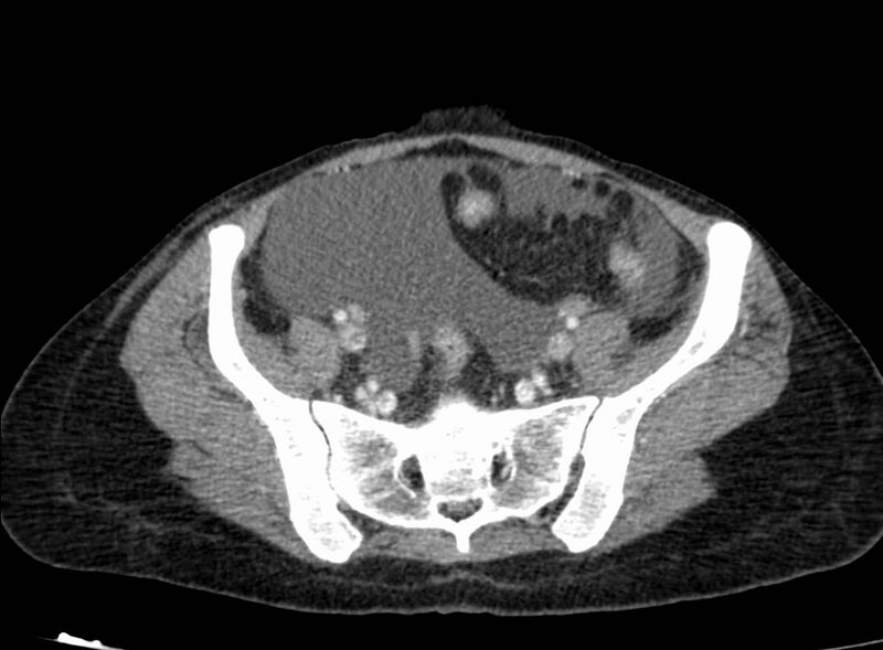 File:Acute Budd-Chiari syndrome (Radiopaedia 60858-68638 Axial C+ portal venous phase 233).jpg