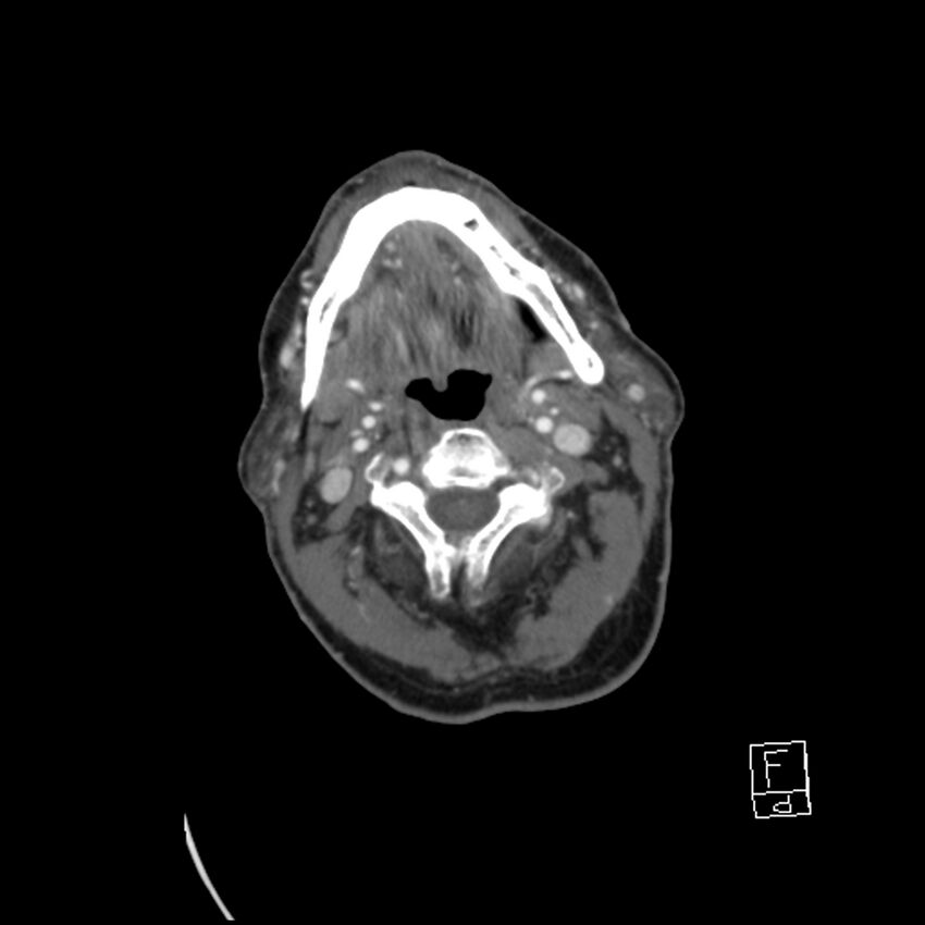 Acute ICA ischemic penumbra due to high-grade CCA stenosis (CT perfusion) (Radiopaedia 72038-82530 Axial C+ arterial phase 36).jpg