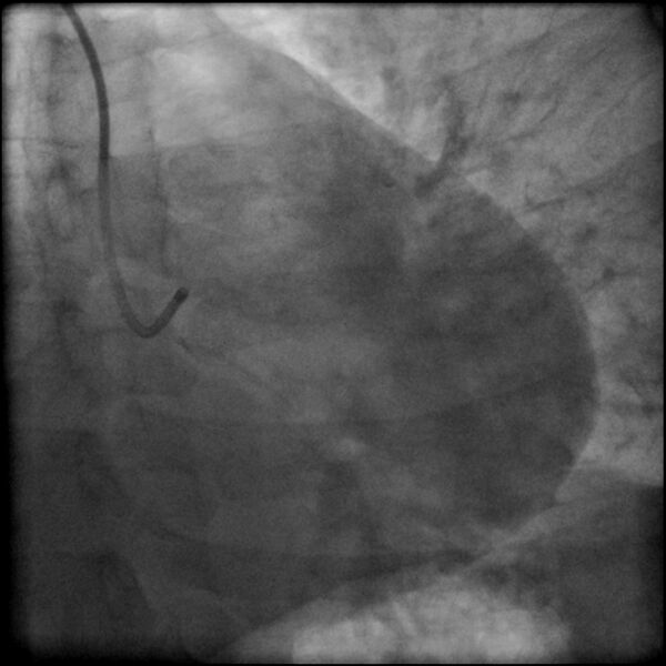 File:Acute anteroseptal myocardial infarction (Radiopaedia 68409-77946 LAO caudal (spider view) LAD and CX 1).jpg