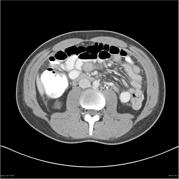 File:Acute appendicitis (Radiopaedia 25364-25615 B 30).jpg