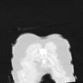 Acute aspiration pneumonitis (Radiopaedia 33605-34703 Coronal lung window 7).jpg