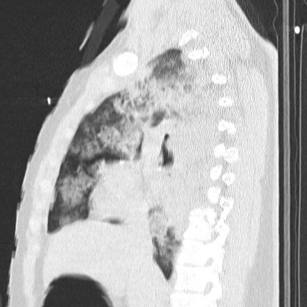 File:Acute aspiration pneumonitis (Radiopaedia 33605-34703 Sagittal lung window 39).jpg