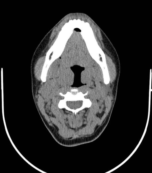 File:Acute bacterial tonsillitis (Radiopaedia 22882-22908 Axial non-contrast 22).png