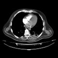 Acute heart failure (CT) (Radiopaedia 79835-93075 Axial C+ arterial phase 31).jpg