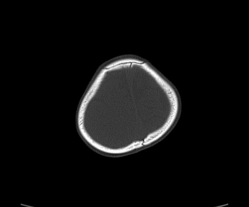 Acute hemorrhagic contusion (Radiopaedia 63660-72336 Axial bone window 60).jpg