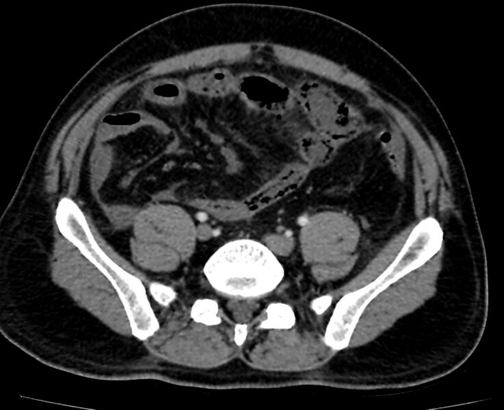 File:Acute mesenteric ischemia - superior mesenteric artery thrombosis (Radiopaedia 73947-84776 Axial C+ arterial phase 114).jpg