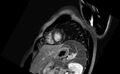 Acute myocarditis (Radiopaedia 77023-88967 Short axis stack LGE 3).jpg
