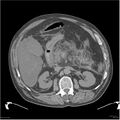 Acute pancreatitis (Radiopaedia 19135-19116 Axial non-contrast 17).jpg