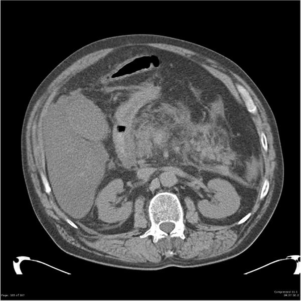 File:Acute pancreatitis (Radiopaedia 19135-19116 Axial non-contrast 17).jpg