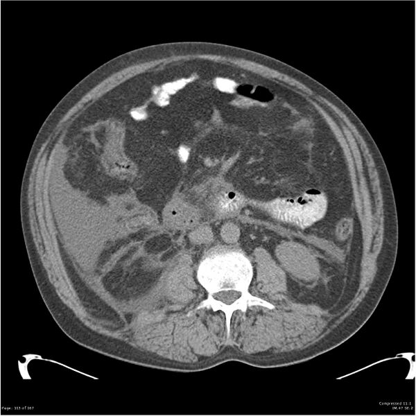 File:Acute pancreatitis (Radiopaedia 19135-19116 Axial non-contrast 27).jpg