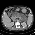 Acute pancreatitis with walled off pancreatic necrosis (Radiopaedia 6438-7797 Axial C+ portal venous phase 5).jpg
