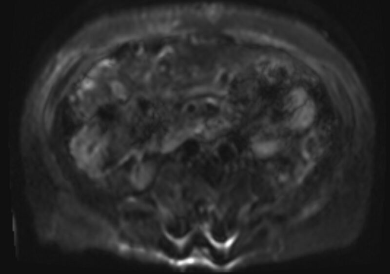 File:Acute portal vein thrombosis (Radiopaedia 73198-83925 Axial DWI 25).jpg