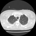 Acute pulmonary edema on CT (Radiopaedia 33582-34672 Axial lung window 8).jpg