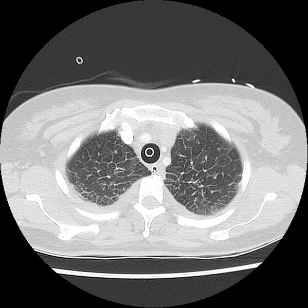 File:Acute pulmonary edema on CT (Radiopaedia 33582-34672 Axial lung window 8).jpg