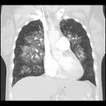 Acute pulmonary edema on CT (Radiopaedia 33582-34672 Coronal lung window 14).jpg