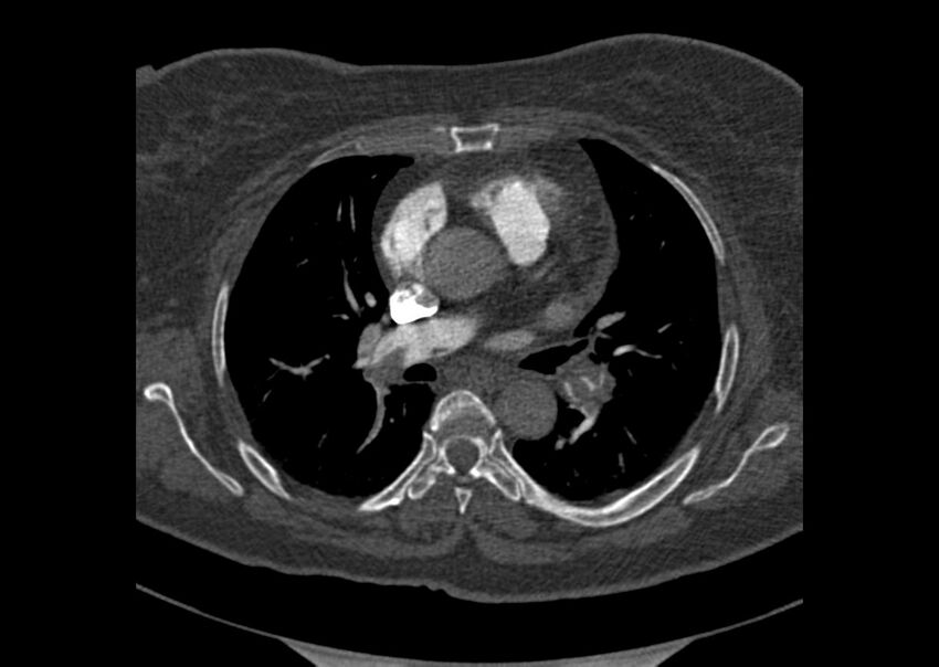 Acute pulmonary embolism (Radiopaedia 29938-30466 Axial C+ CTPA 70).jpg